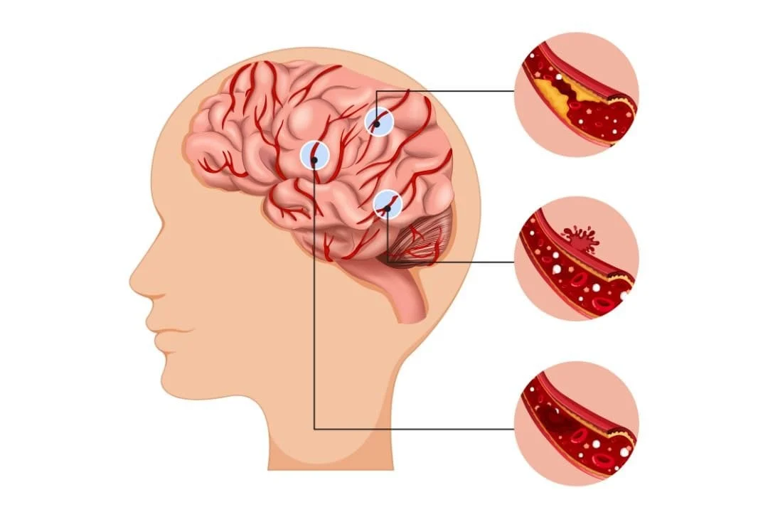 Dampak Sistem Rujukan pada Pasien Stroke di Indonesia