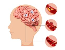 Dampak Sistem Rujukan pada Pasien Stroke di Indonesia